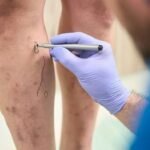 Exploring the Long-term Effects of Varicose Veins