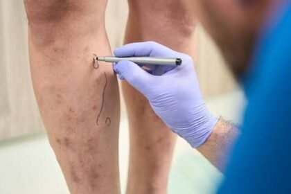 Exploring the Long-term Effects of Varicose Veins