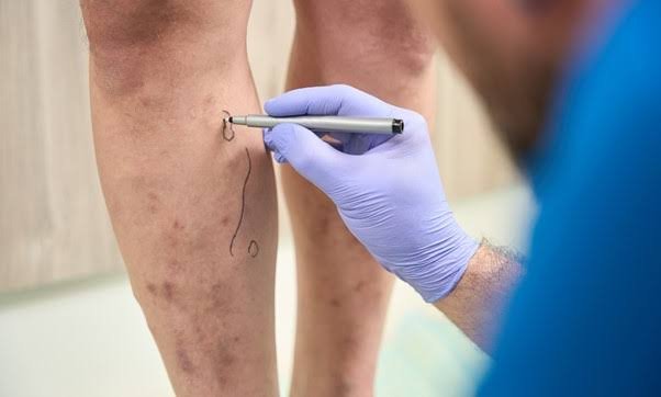 Exploring the Long-term Effects of Varicose Veins