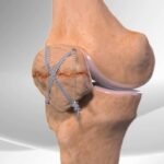 Understanding the Limitations of Disc Replacement Surgery