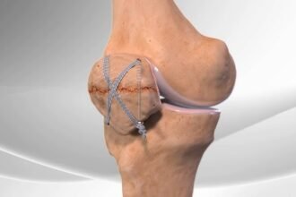 Understanding the Limitations of Disc Replacement Surgery