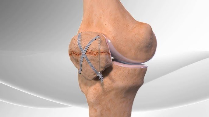 Understanding the Limitations of Disc Replacement Surgery